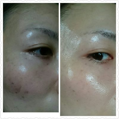 ハーブピーリング