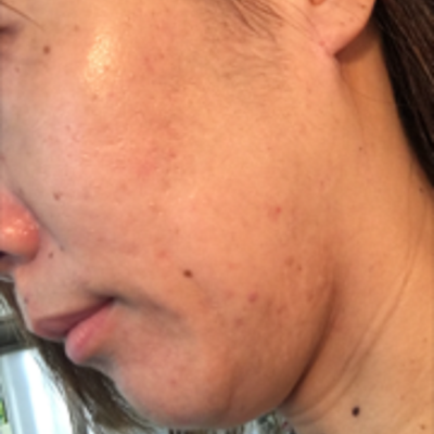 『繰り返すニキビから脱出！それは、、、』