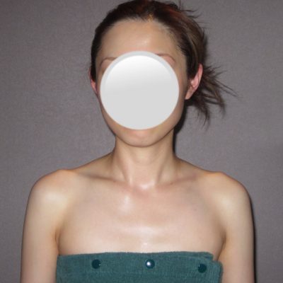 骨格調整（ブライダル編）A様