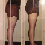 腿裏セルライト