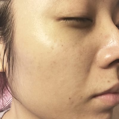 ほうれい線が・・・・～リベルその後～