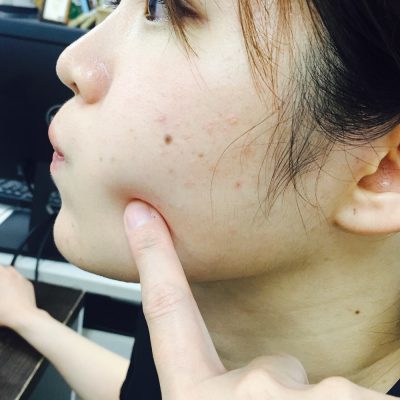 再生美容で即効！！