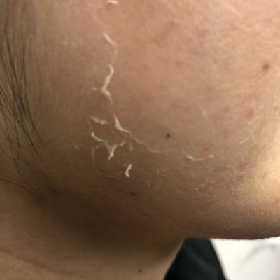 一皮、剥けました！！