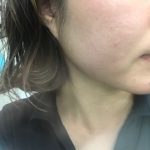 ～ハーブピーリング直後のお肌～