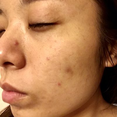 芽吹きの季節はお肌に要注意!