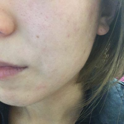 ひりひり肌よさようなら~