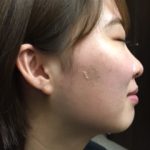 ハーブピーリング剥離中