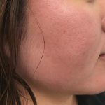 リベル・ハーブピーリング変化写真