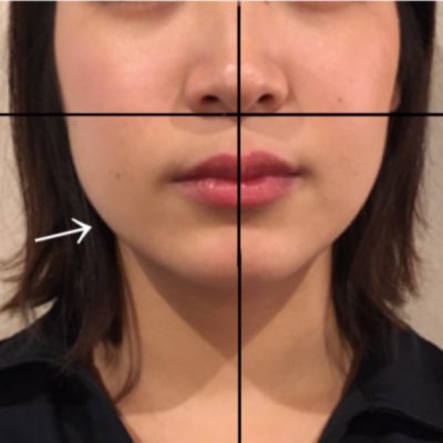 【エラ張り型】骨格ではないかも知れません