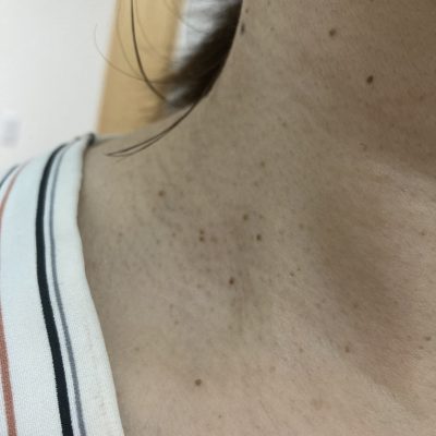 老人性イボご存じですか？